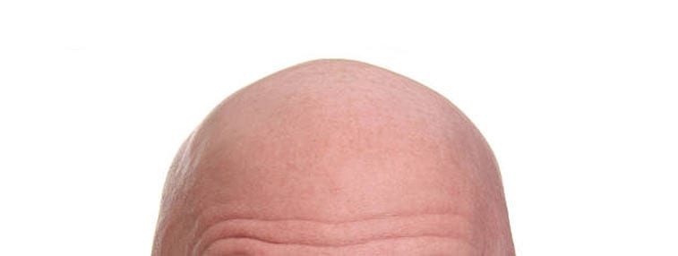 the top of a bald man's head