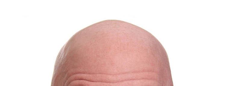 the top of a bald man's head
