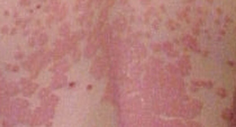 redness on skin