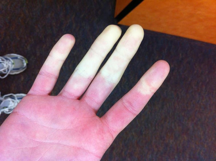 can raynauds cause damage