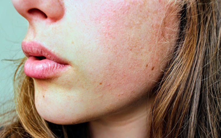 a woman with a slight rash on her face